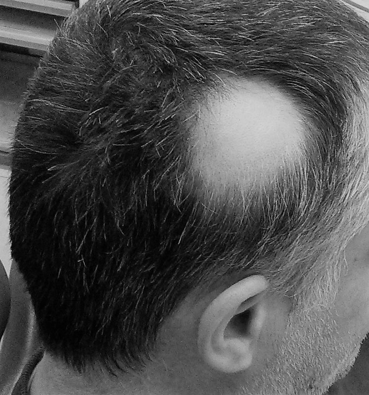 Scalp Micropigmentation Blog
