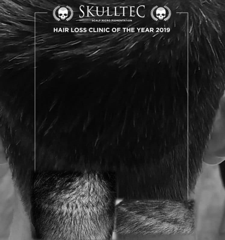 Scalp Micropigmentation Blog