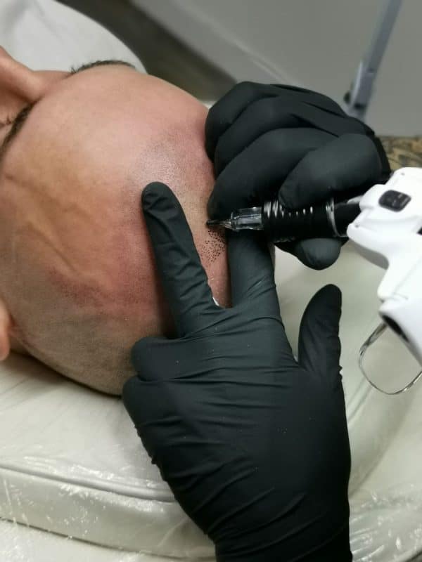 Scalp Micropigmentation Blog