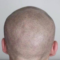 What is the recovery time after scalp micropigmentation