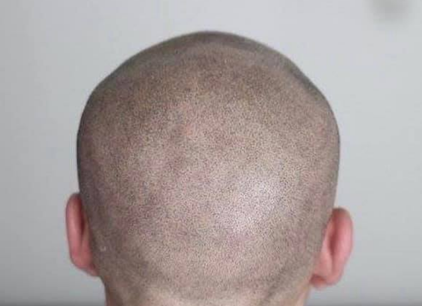 What is Scalp MicroPigmentation?