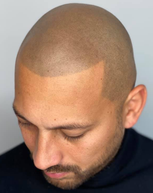 Scalp Micropigmentation Blog