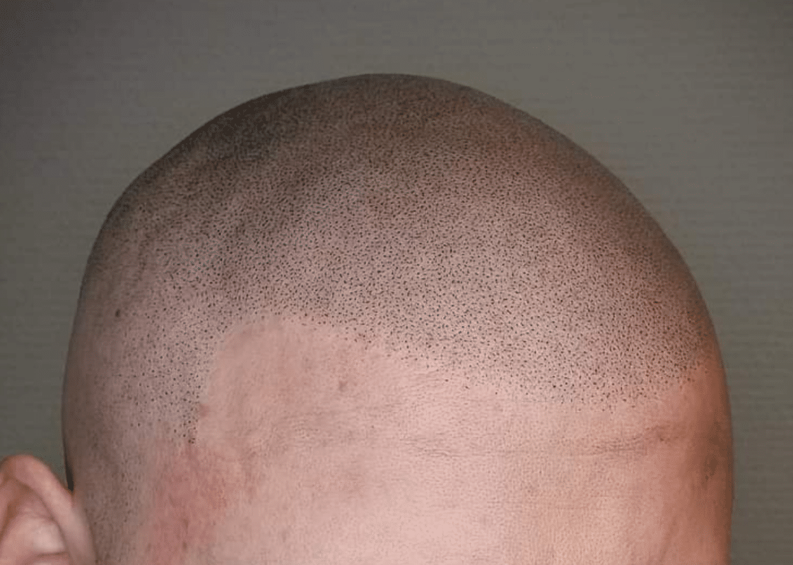 Scalp Micropigmentation Blog