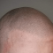 scalp micropigmentation Training