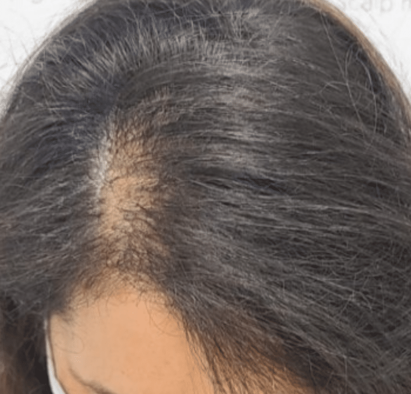 Scalp Micropigmentation Blog