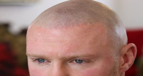 Taking Care of Yourself After Scalp Micropigmentation Procedure