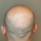 How long does the scalp micropigmentation procedure take