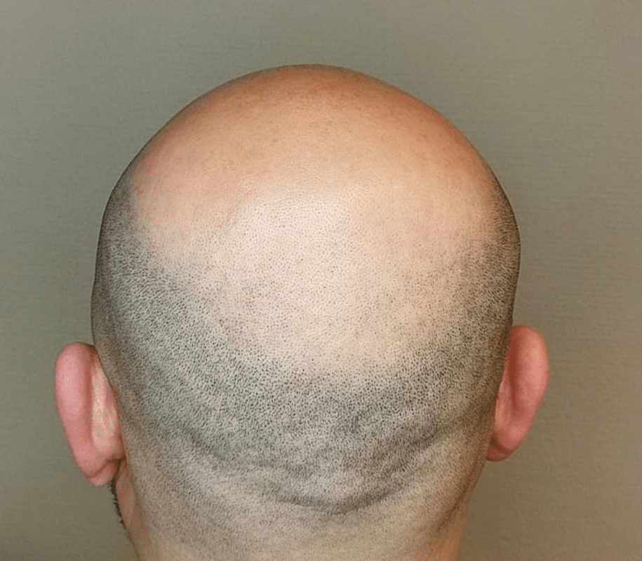 Scalp Micropigmentation Blog