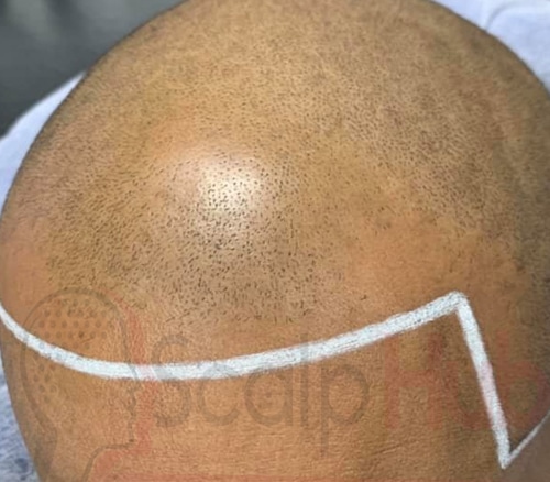 Will Scalp Micropigmentation Fix My Hairline