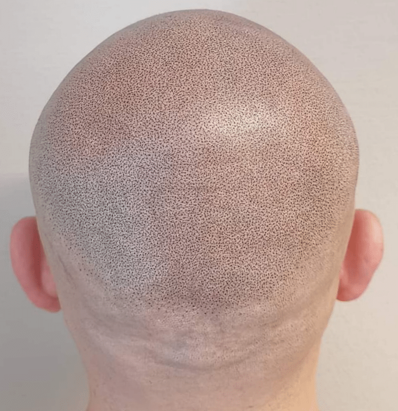 Scalp Micropigmentation Blog