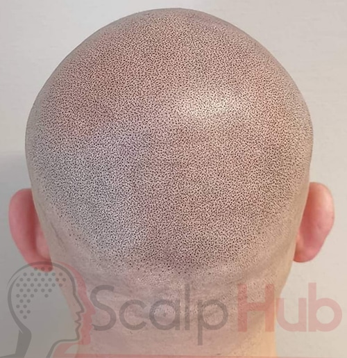 How To Shave When You’ve Had Scalp Micropigmentation