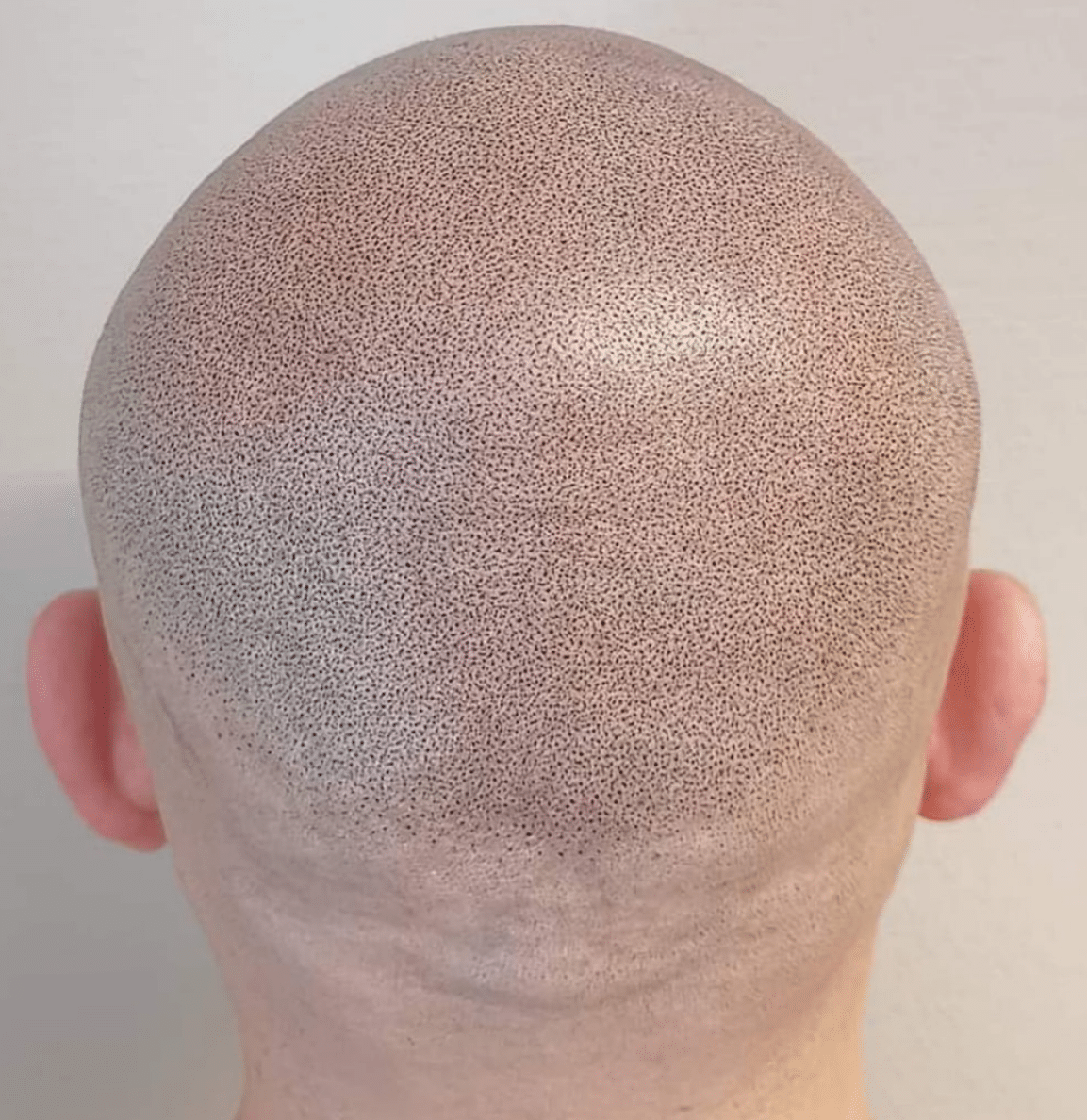 How To Shave When You’ve Had Scalp Micropigmentation