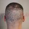 Can I still shave my head after getting scalp micropigmentation