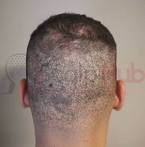 Scalp Micro pigmentation for Hair transplant before