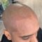 Does scalp micropigmentation affect hair growth?