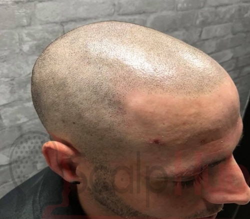 Experiencing A Shining Head After Scalp Micropigmentation