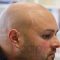 Can scalp micropigmentation be reversed or removed if desired