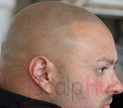 Experiencing A Shining Head After Scalp Micropigmentation