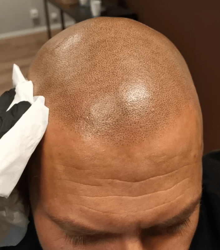 Scalp Micropigmentation Blog