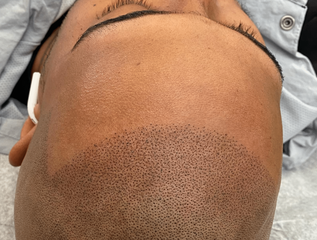 Scalp Micropigmentation Blog