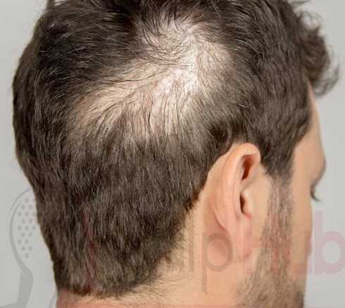 Scalp Tattoo, Hair Tattoo, Scalp Micropigmentation; What do all these terms mean in 2021?