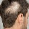 Does scalp micropigmentation help if I have alopecia?