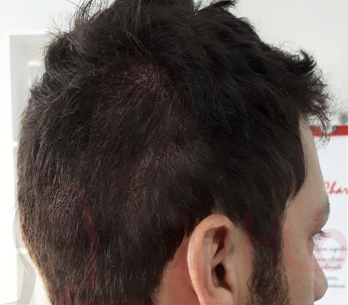 Scalp Tattoo, Hair Tattoo, Scalp Micropigmentation; What do all these terms mean?