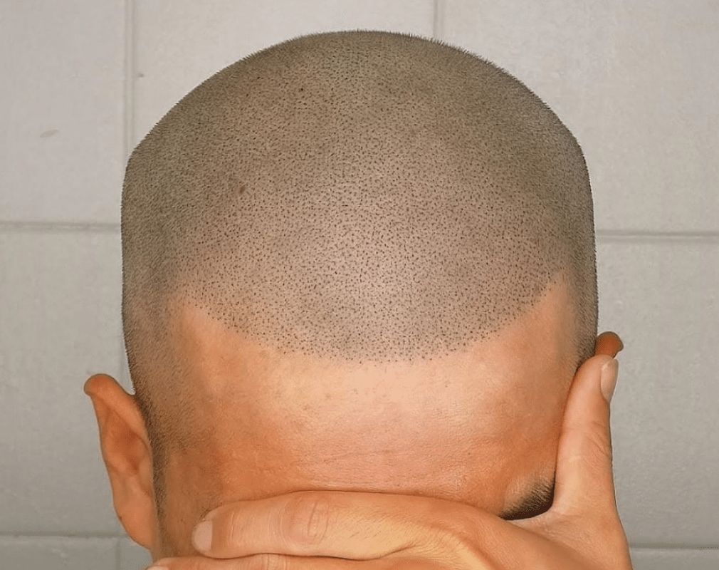 Scalp Micropigmentation Blog