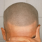 Will scalp micropigmentation fade over time