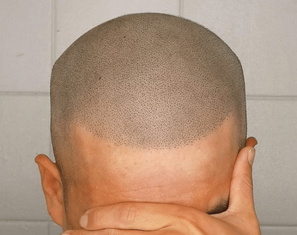 What Should You Expect During Your Scalp Micropigmentation Session?