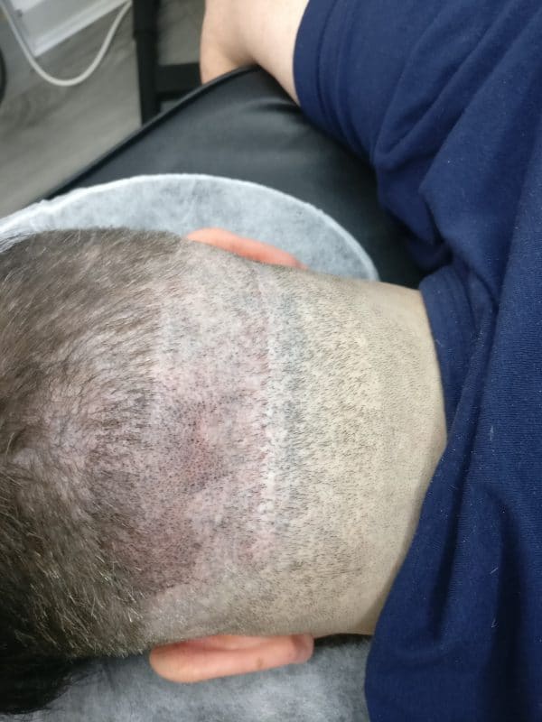 Scalp Micropigmentation Blog
