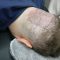 Is a hair transplant possible after getting scalp micropigmentation?