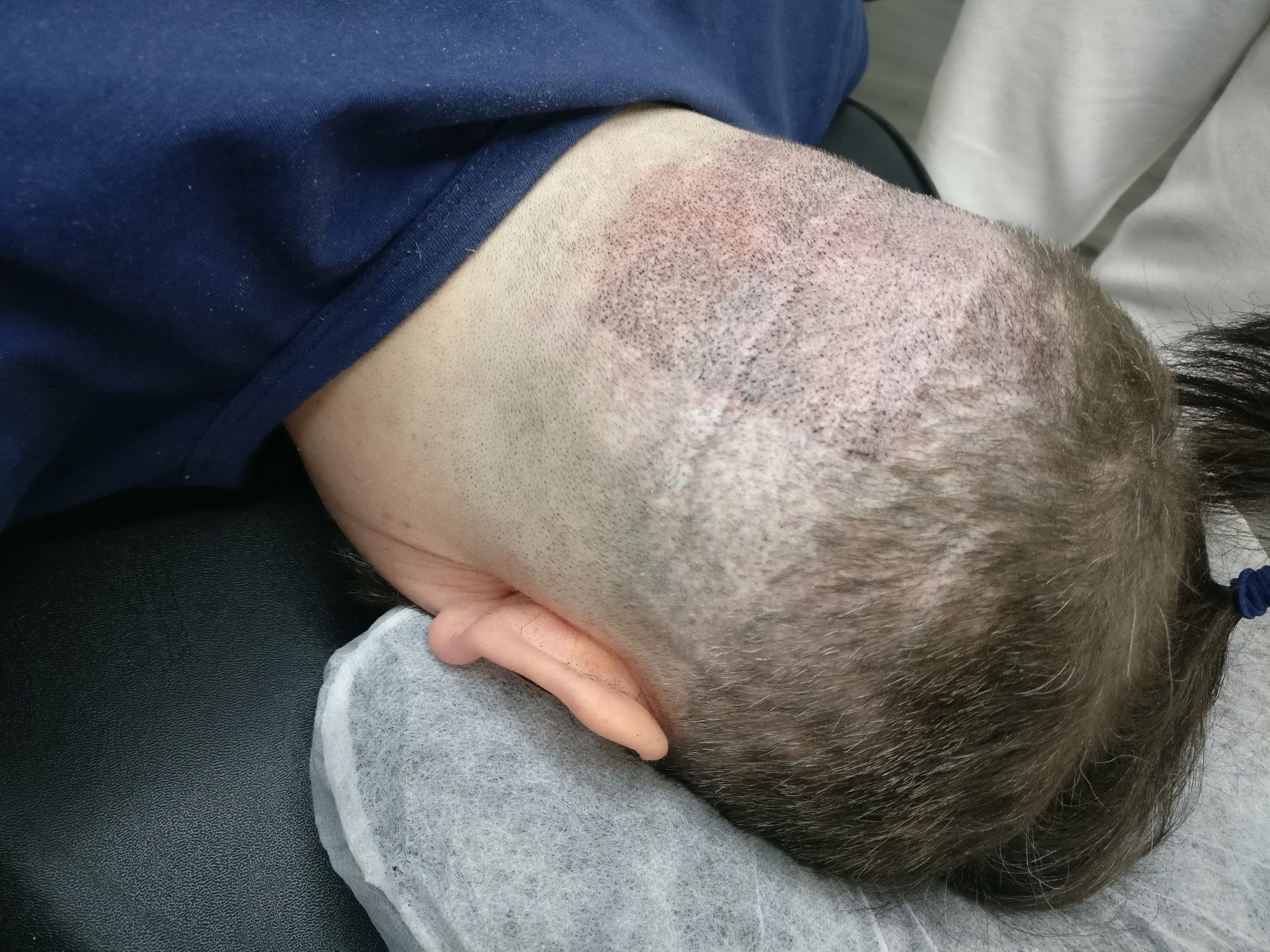 Is a hair transplant possible after getting scalp micropigmentation?