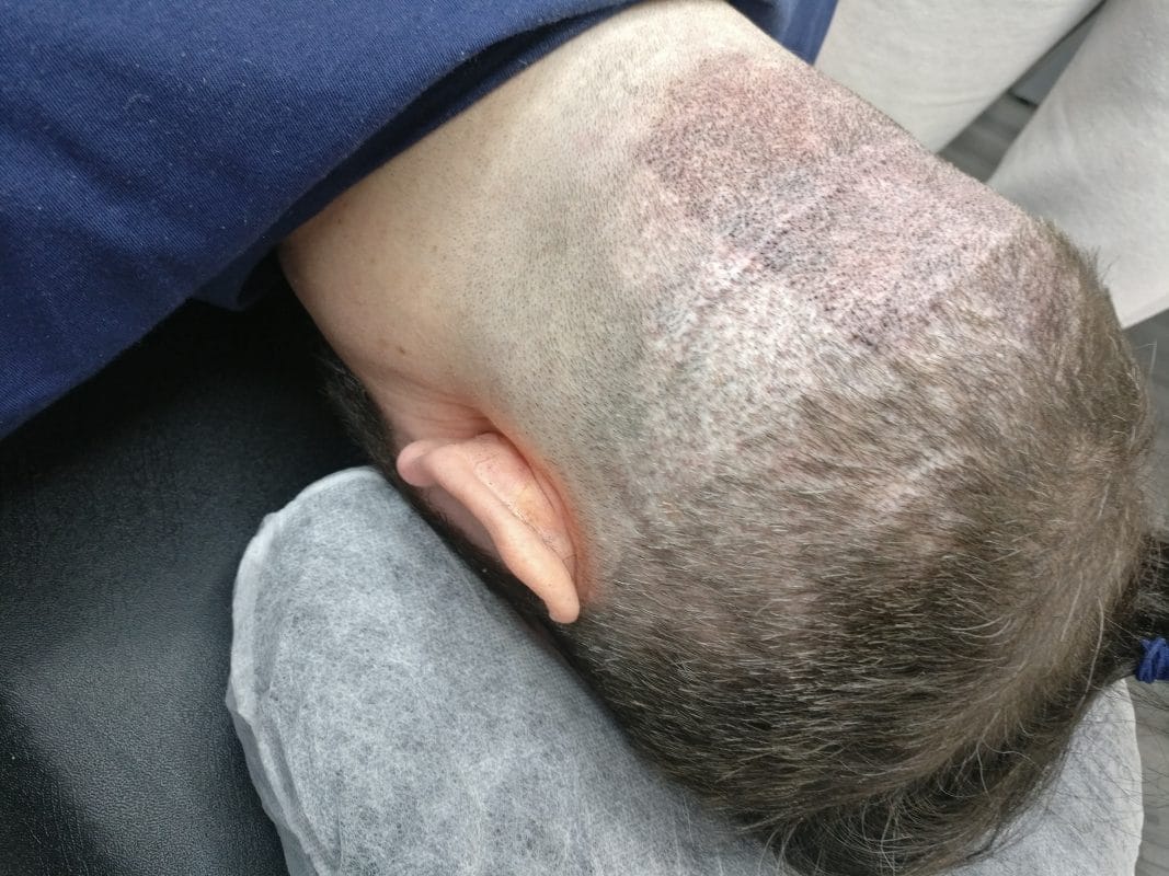 Scalp Micropigmentation Blog