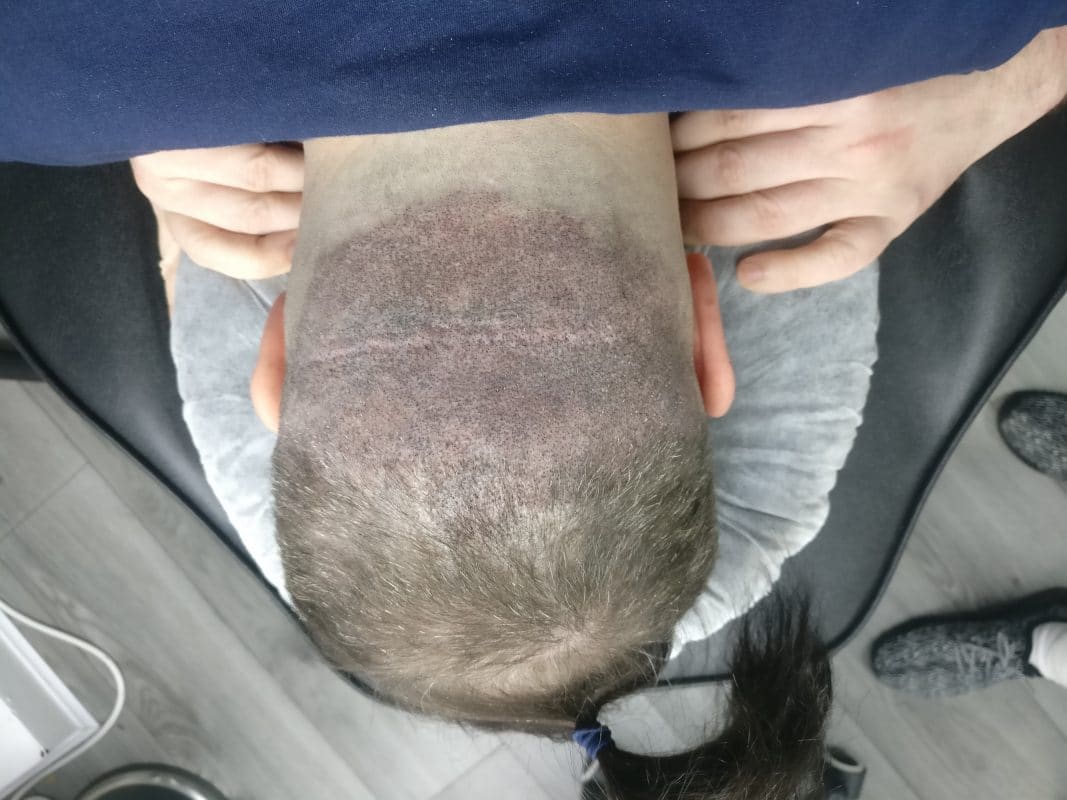 Scalp Micropigmentation Blog