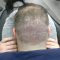 Can scalp micropigmentation camouflage scars or birthmarks on the scalp