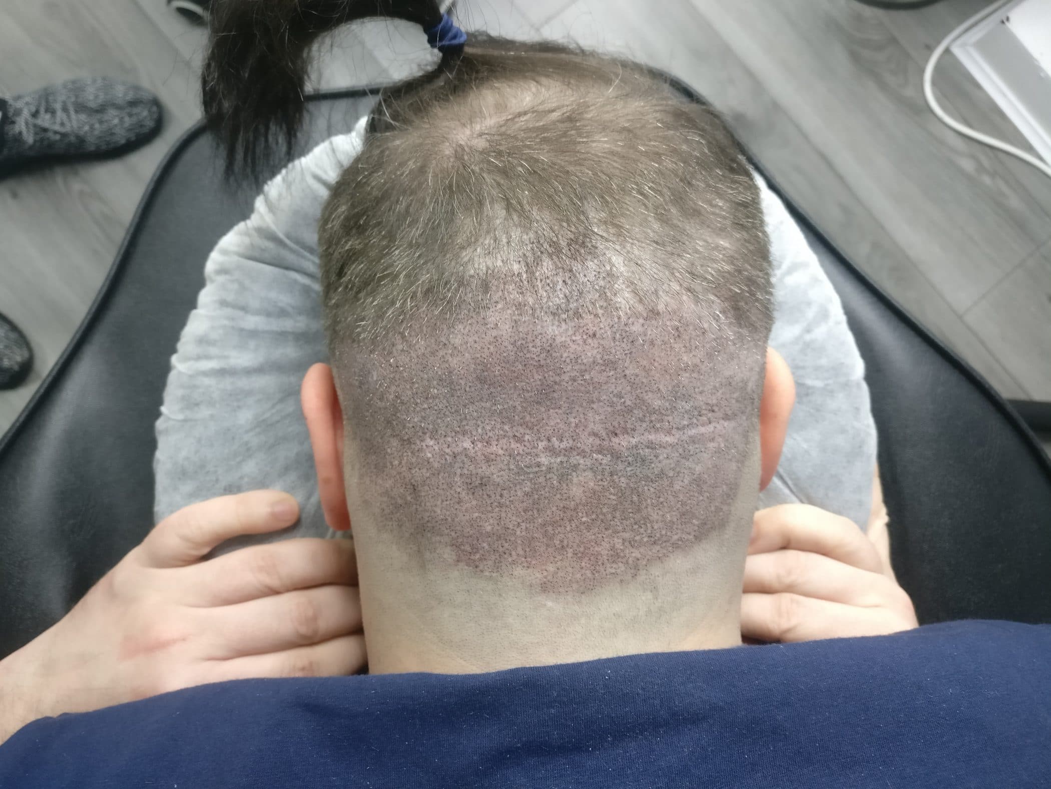 Scalp micropigmentation and getting a hair transplant
