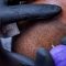 Does scalp micropigmentation hurt