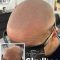 Can I dye my hair after scalp micropigmentation